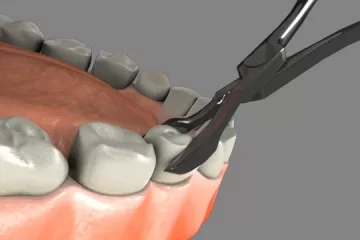 extraction