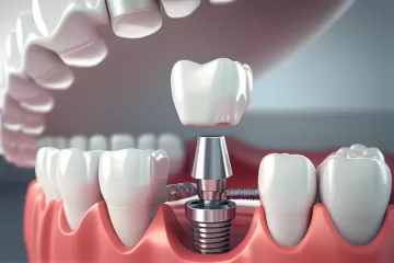 Removable partial denture. Medically accurate tooth.generative ai